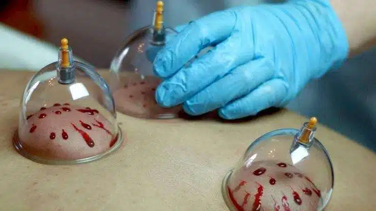 דימום לתוך כוס רוח